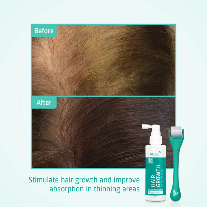 4x Neofollics lotion + free scalp roller