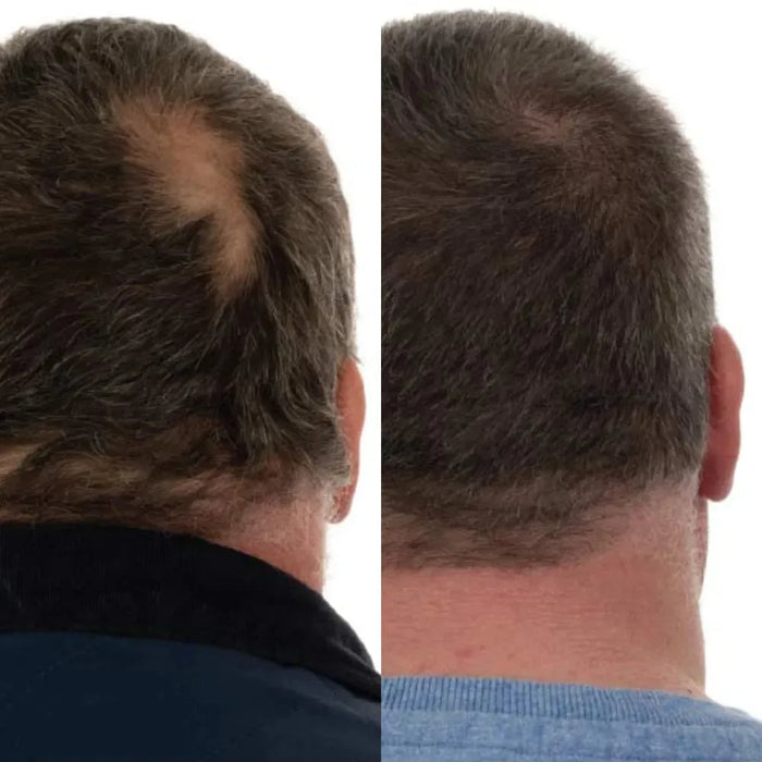 Foligain hair loss shampoo men (473 ml) - Hairgivers
