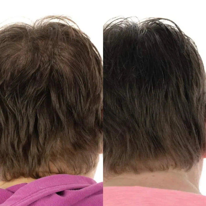 Foligain hair growth treatment (women) - Hairgivers