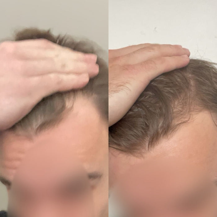 Scandinavian Biolabs Bio-Pilixin Hairline Booster