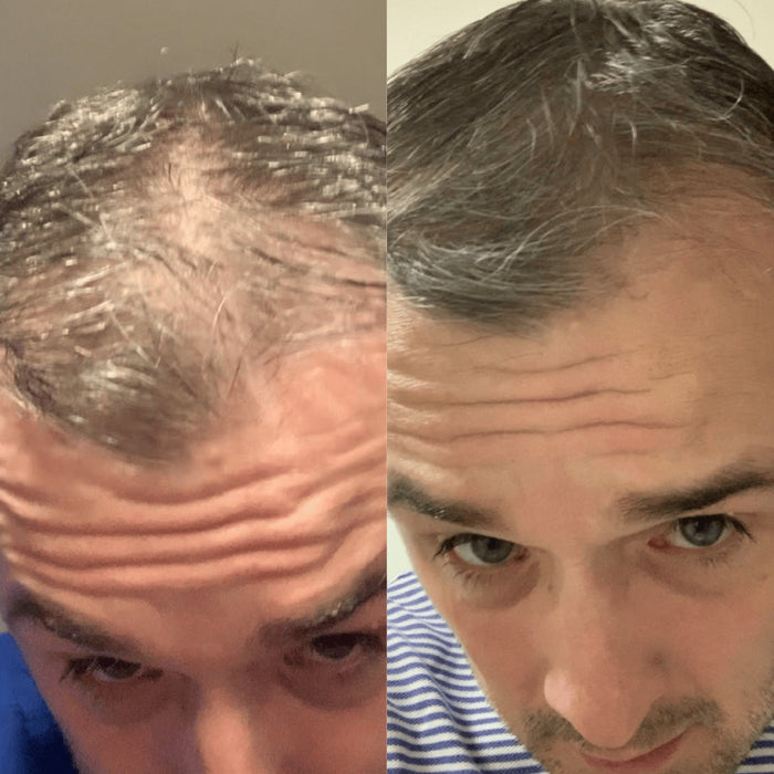 Scandinavian Biolabs Bio-Pilixin Hairline Booster